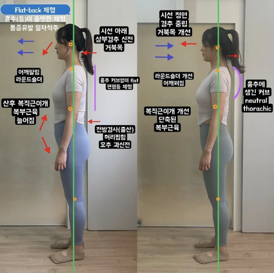 포즈필라테스 비포애프터 — Flat-back 체형 · 산후 복직근이개