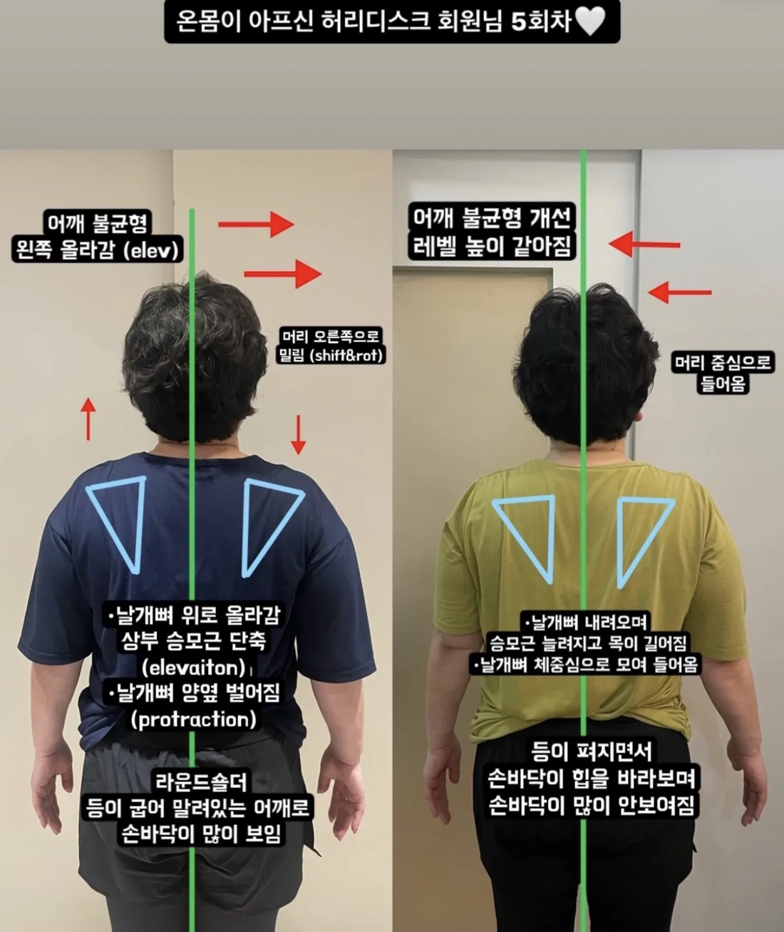 포즈필라테스 비포애프터 — 허리디스크 회원 5회차